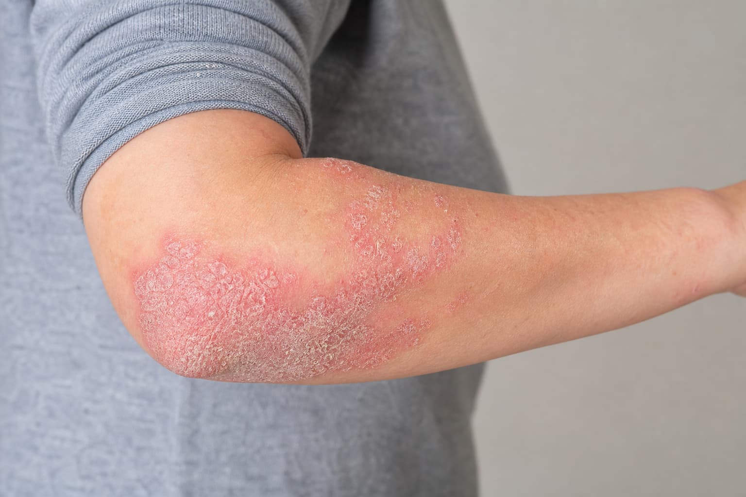 Psoriasis och hudvård: Skonsam vård av torr, känslig hud