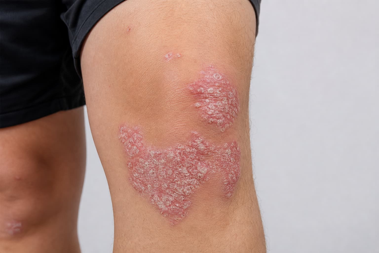 Vad är psoriasis? Förstå tillståndet